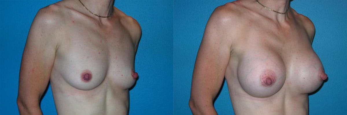 Breast Augmentation Before & After Gallery - Patient 340526 - Image 1