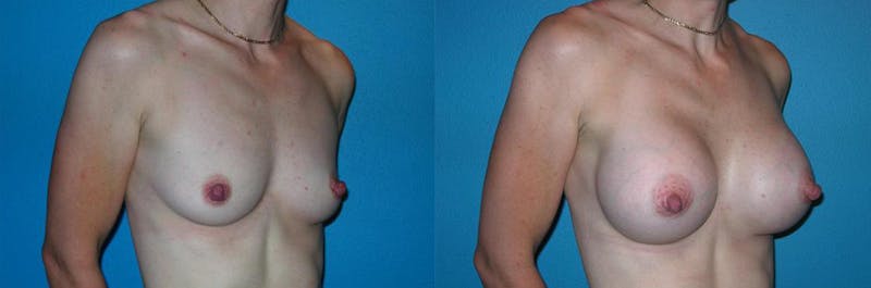 Breast Augmentation Before & After Gallery - Patient 340526 - Image 1
