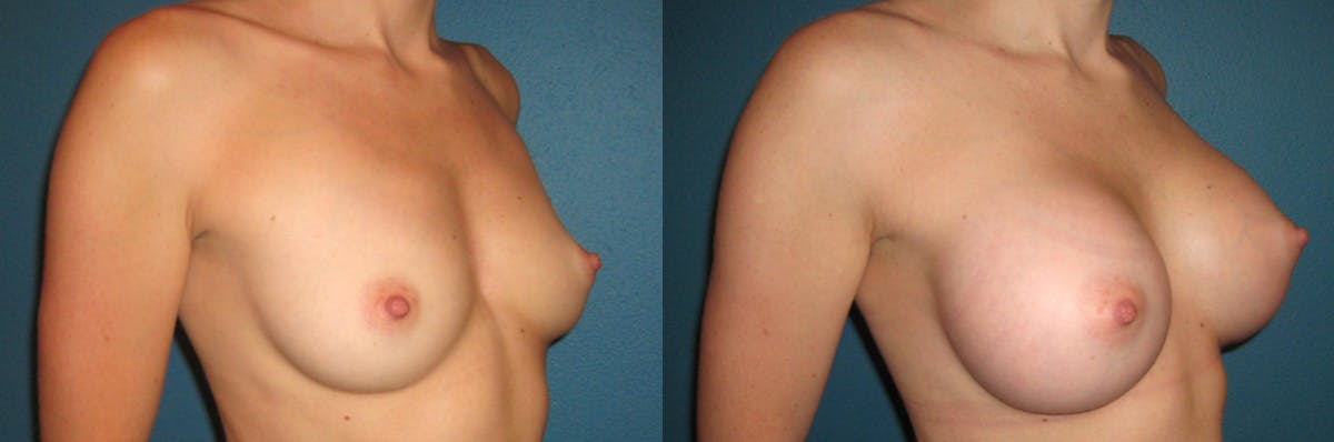Breast Augmentation Before & After Gallery - Patient 308622 - Image 1