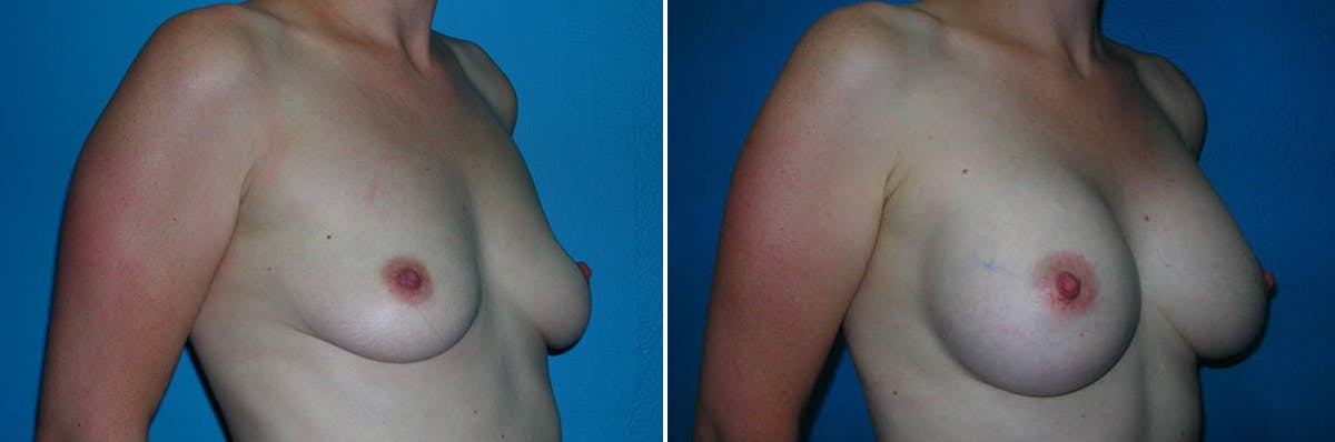 Breast Augmentation Before & After Gallery - Patient 407895 - Image 1