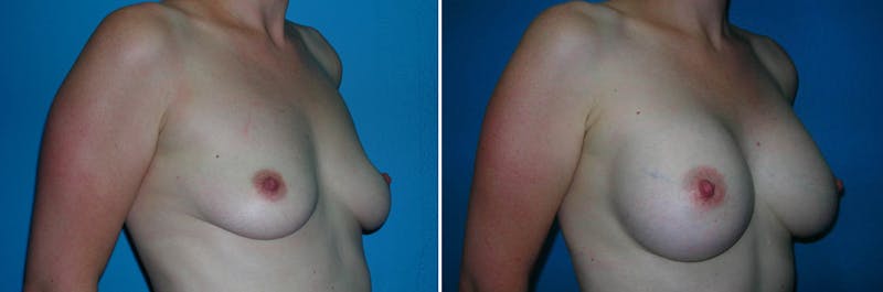Breast Augmentation Before & After Gallery - Patient 407895 - Image 1