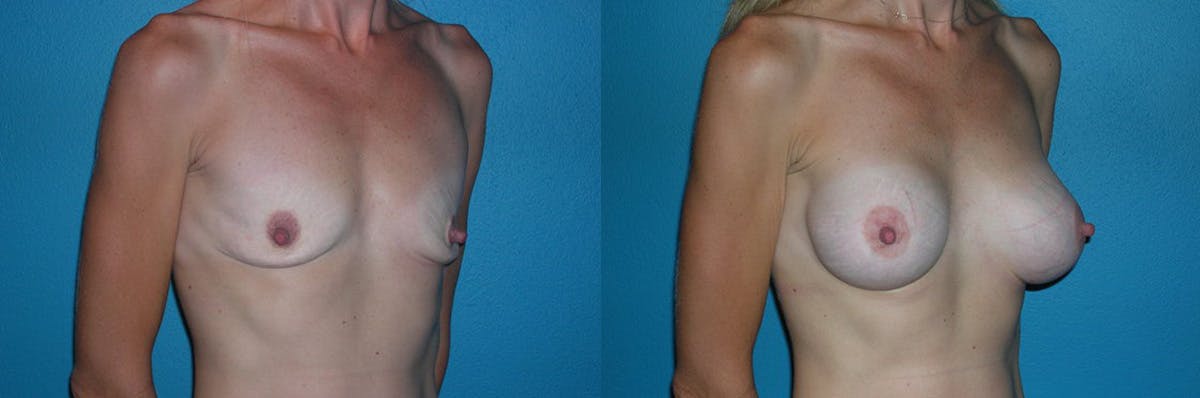 Breast Augmentation Before & After Gallery - Patient 231097 - Image 1