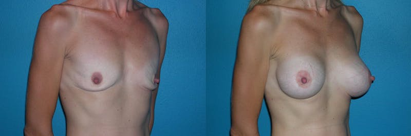 Breast Augmentation Before & After Gallery - Patient 231097 - Image 1