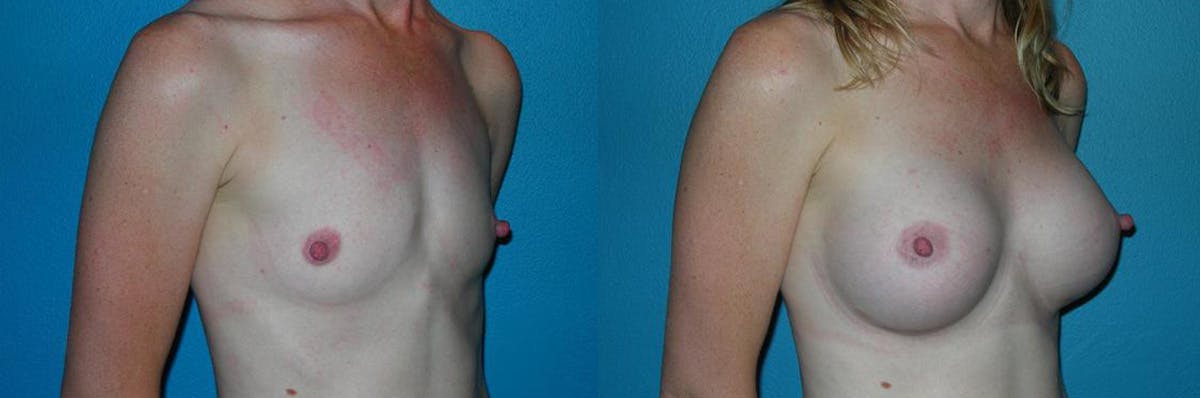Breast Augmentation Before & After Gallery - Patient 168873 - Image 1