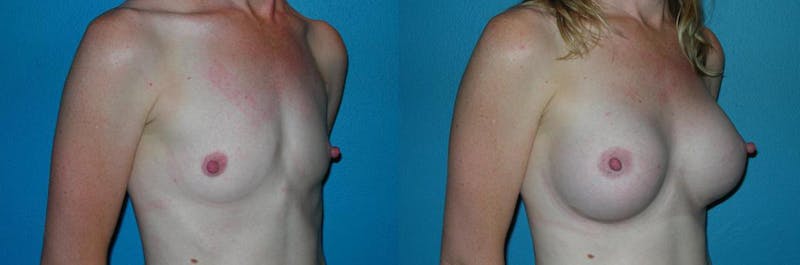 Breast Augmentation Before & After Gallery - Patient 168873 - Image 1