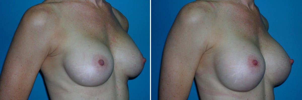 Breast Augmentation Before & After Gallery - Patient 276505 - Image 1