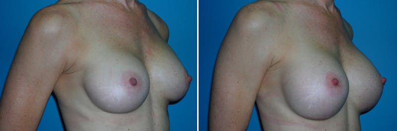 Breast Augmentation Before & After Gallery - Patient 276505 - Image 1