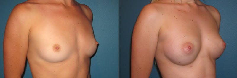 Breast Augmentation Before & After Gallery - Patient 300037 - Image 1