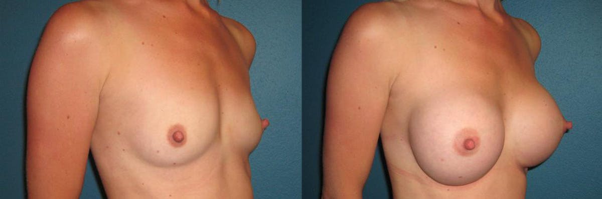 Breast Augmentation Before & After Gallery - Patient 307352 - Image 1