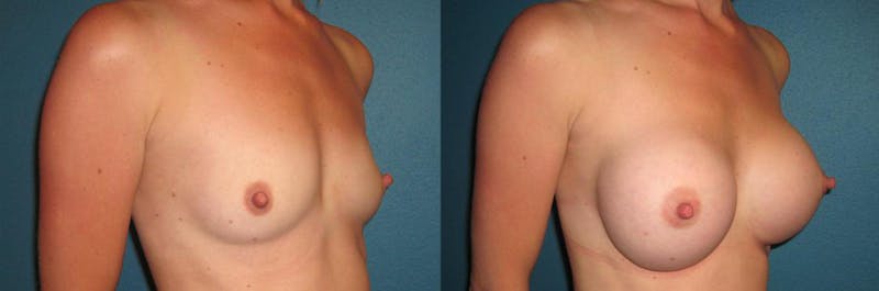 Breast Augmentation Before & After Gallery - Patient 307352 - Image 1