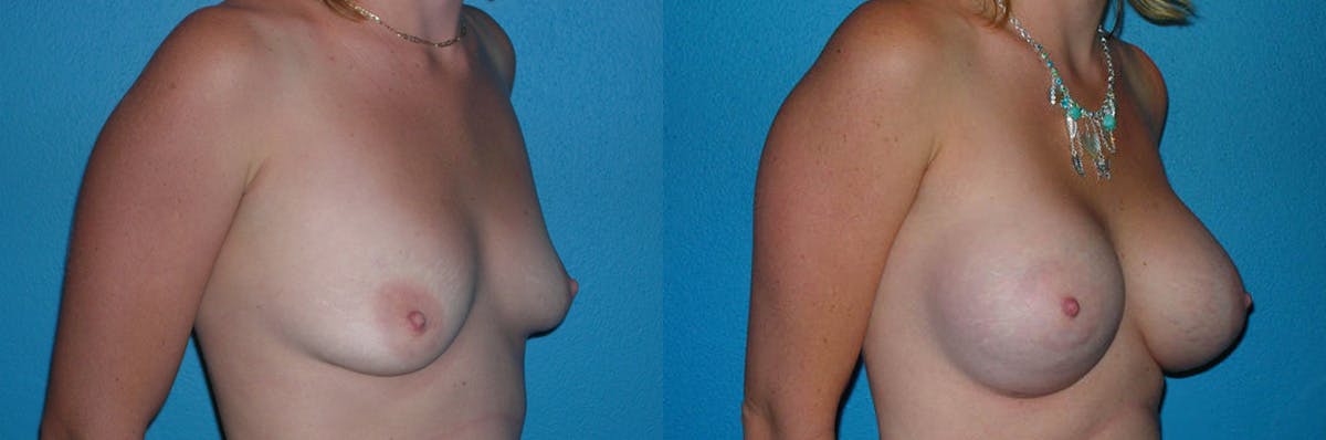 Breast Augmentation Before & After Gallery - Patient 377516 - Image 1