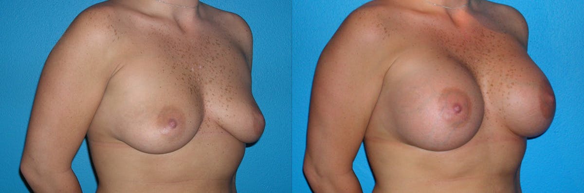 Breast Augmentation Before & After Gallery - Patient 213721 - Image 1