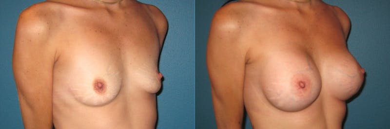 Breast Augmentation Before & After Gallery - Patient 312223 - Image 1
