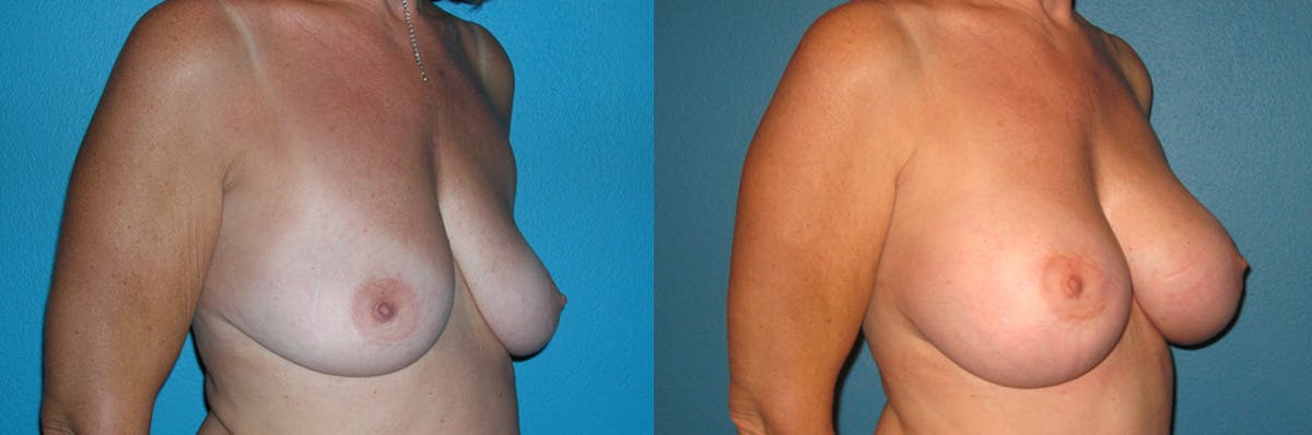 Breast Augmentation Before & After Gallery - Patient 886748 - Image 1