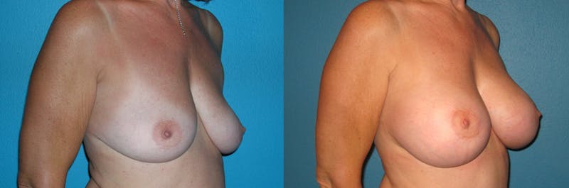 Breast Augmentation Before & After Gallery - Patient 886748 - Image 1