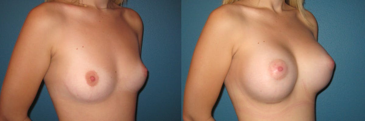 Breast Augmentation Before & After Gallery - Patient 478893 - Image 1