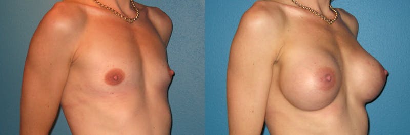 Breast Augmentation Before & After Gallery - Patient 200693 - Image 1