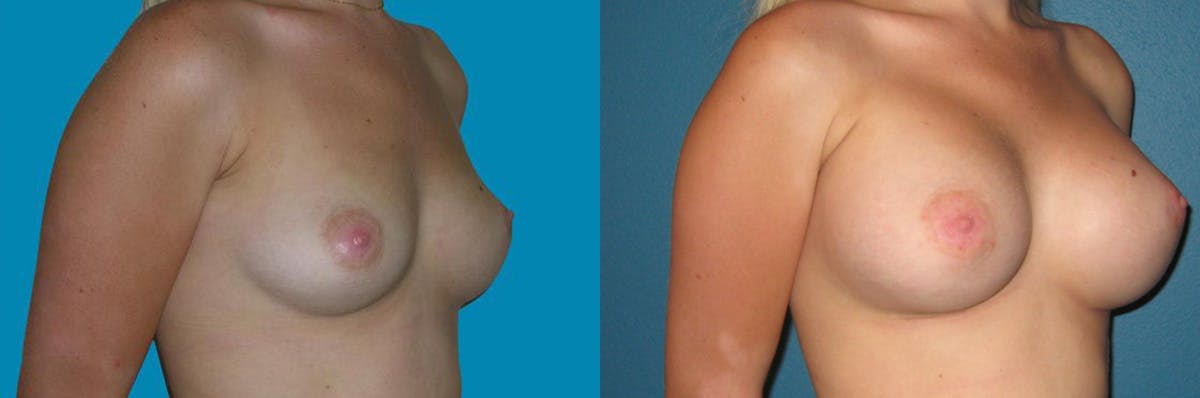 Breast Augmentation Before & After Gallery - Patient 233545 - Image 1