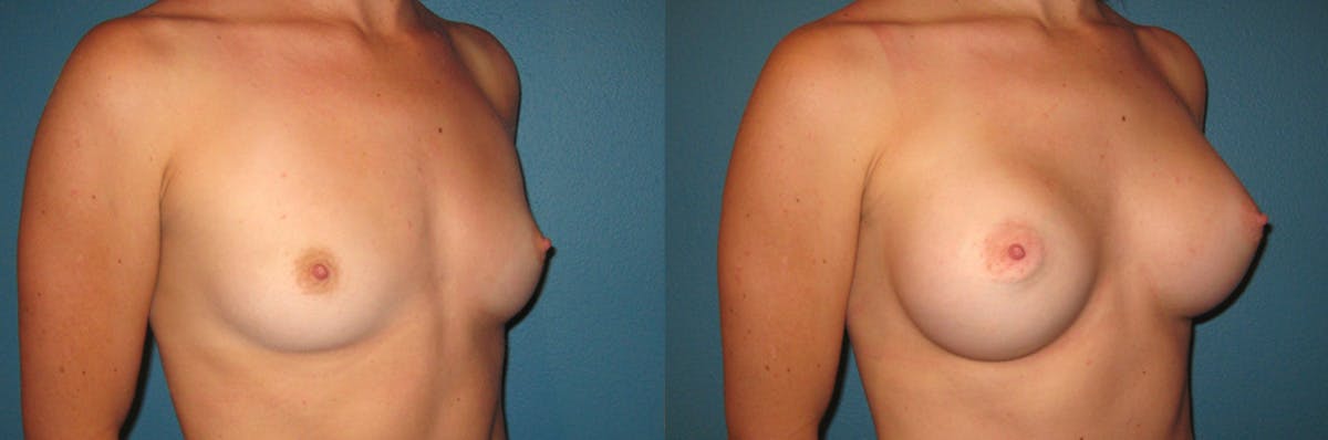Breast Augmentation Before & After Gallery - Patient 354377 - Image 1
