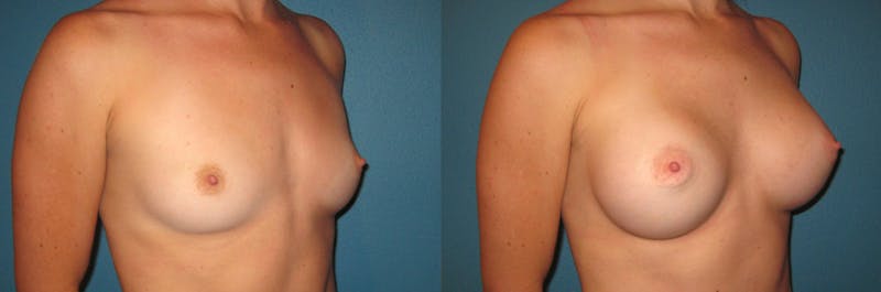 Breast Augmentation Before & After Gallery - Patient 354377 - Image 1