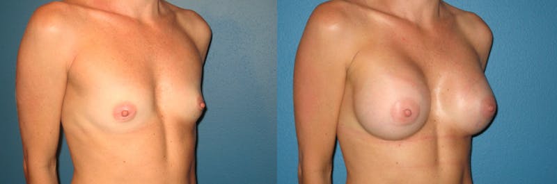 Breast Augmentation Before & After Gallery - Patient 197137 - Image 1