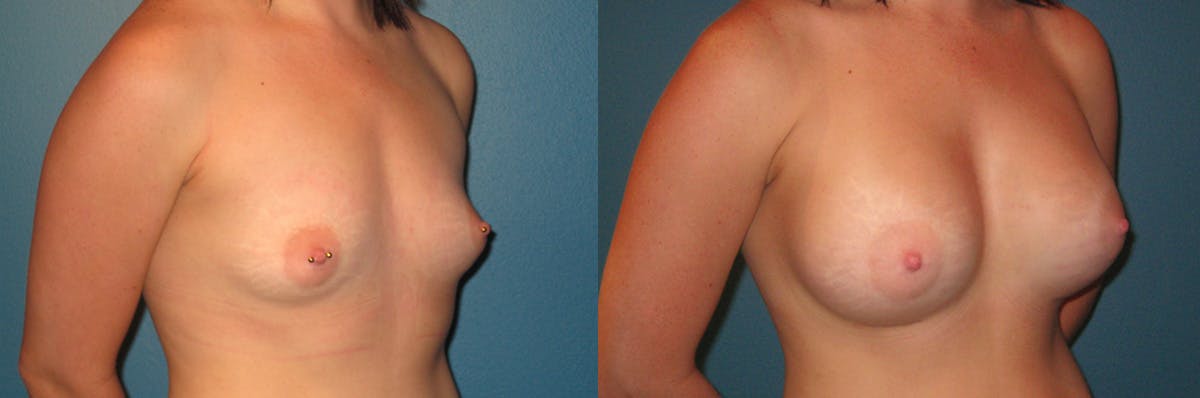 Breast Augmentation Before & After Gallery - Patient 314583 - Image 1