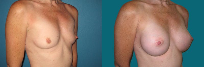 Breast Augmentation Before & After Gallery - Patient 433466 - Image 1