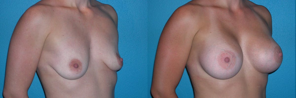 Breast Augmentation Before & After Gallery - Patient 264454 - Image 1