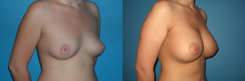 Breast Augmentation Before & After Gallery - Patient 304442 - Image 1