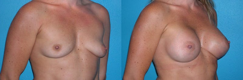 Breast Augmentation Before & After Gallery - Patient 397382 - Image 1