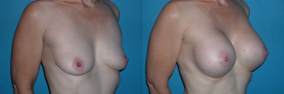 Breast Augmentation Before & After Gallery - Patient 184804 - Image 1