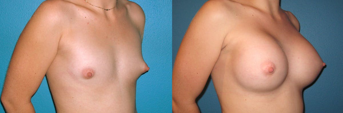 Breast Augmentation Before & After Gallery - Patient 646636 - Image 1