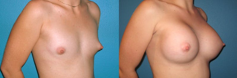 Breast Augmentation Before & After Gallery - Patient 646636 - Image 1