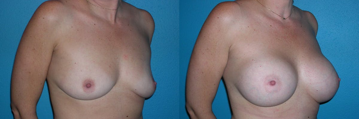 Breast Augmentation Before & After Gallery - Patient 284163 - Image 1