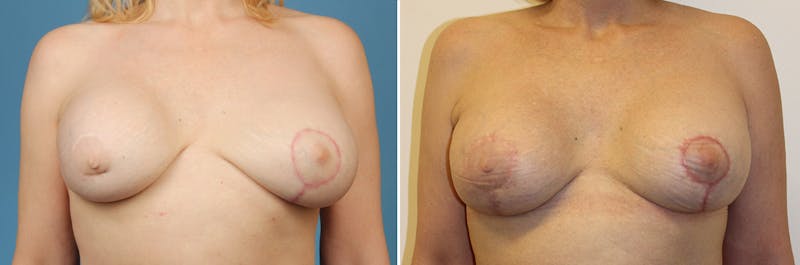 Breast Revision Surgery Before & After Gallery - Patient 466879 - Image 1