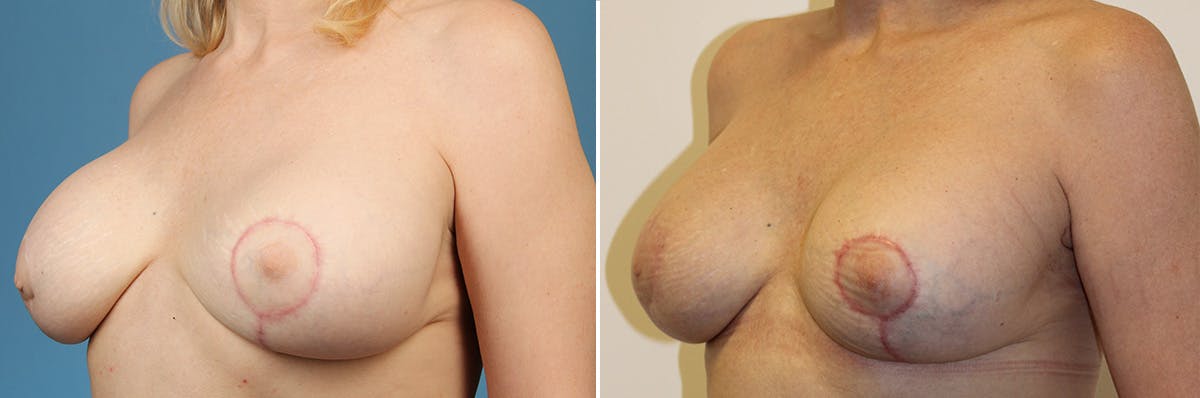 Breast Revision Surgery Before & After Gallery - Patient 466879 - Image 2