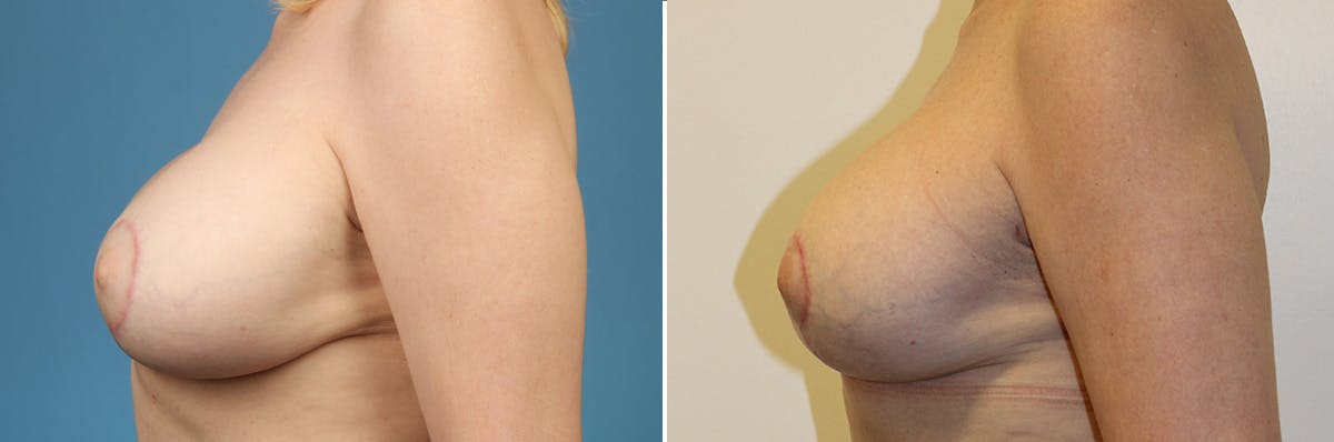 Breast Revision Surgery Before & After Gallery - Patient 466879 - Image 3