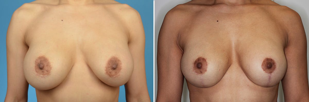 Breast Revision Surgery Before & After Gallery - Patient 847435 - Image 1
