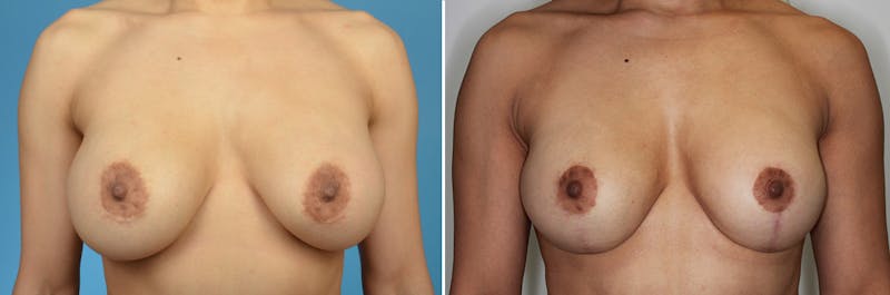 Breast Revision Surgery Before & After Gallery - Patient 847435 - Image 1