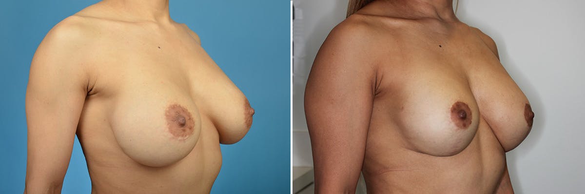 Breast Revision Surgery Before & After Gallery - Patient 847435 - Image 2