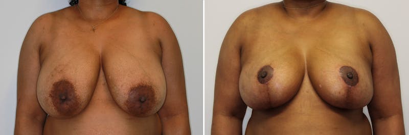 Breast Lift/Reduction Before & After Gallery - Patient 252103 - Image 1