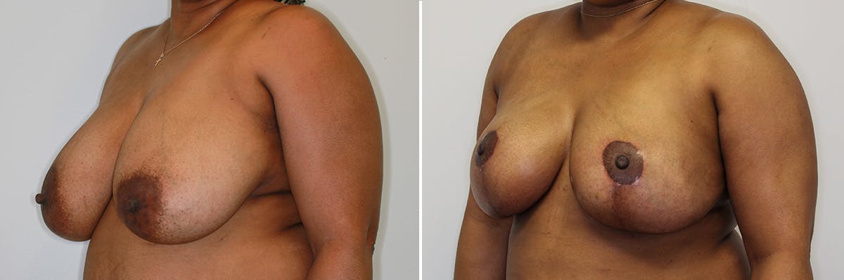 Breast Lift/Reduction Before & After Gallery - Patient 252103 - Image 2