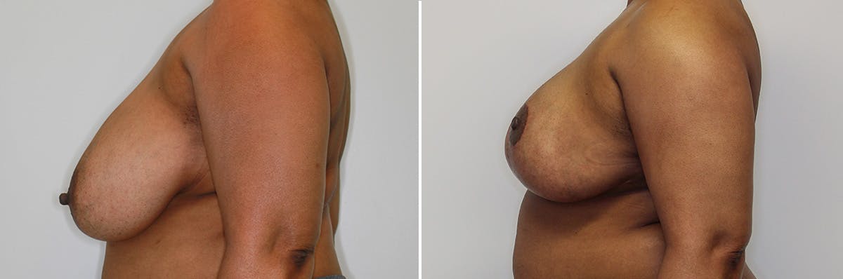 Breast Lift/Reduction Before & After Gallery - Patient 252103 - Image 3