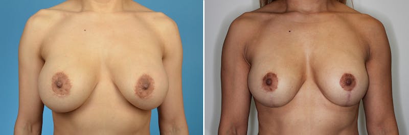 Breast Lift Before & After Gallery - Patient 179062 - Image 1