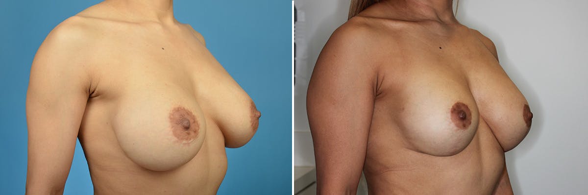 Breast Lift Before & After Gallery - Patient 179062 - Image 2