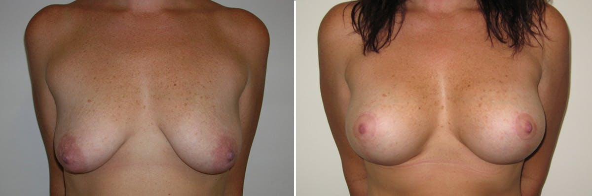 Breast Lift Before & After Gallery - Patient 286847 - Image 1