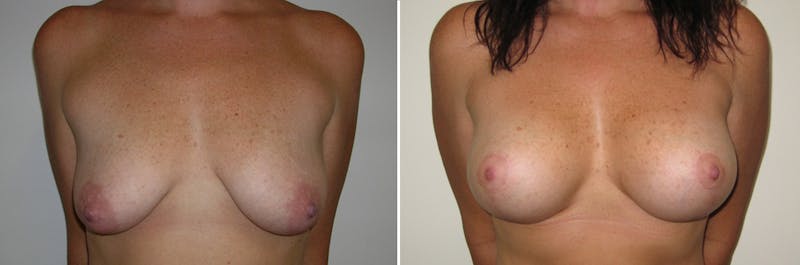 Breast Lift Before & After Gallery - Patient 286847 - Image 1