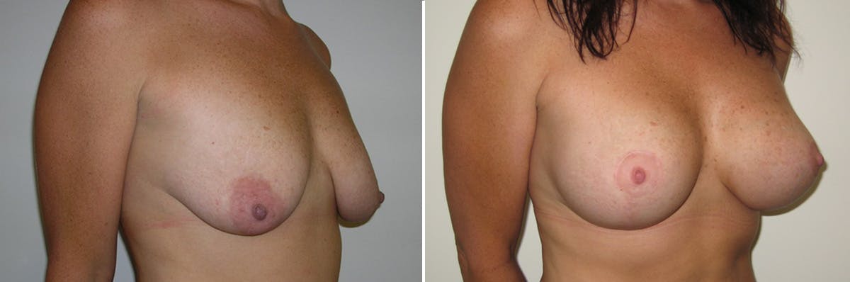 Breast Lift Before & After Gallery - Patient 286847 - Image 2