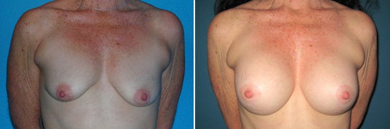 Breast Lift Before & After Gallery - Patient 217201 - Image 1