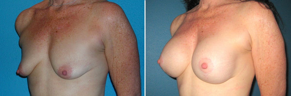 Breast Lift Before & After Gallery - Patient 217201 - Image 2